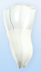 Cracked Tooth